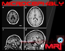 Microcephaly