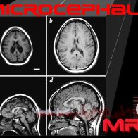 Microcephaly